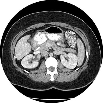 CT Image