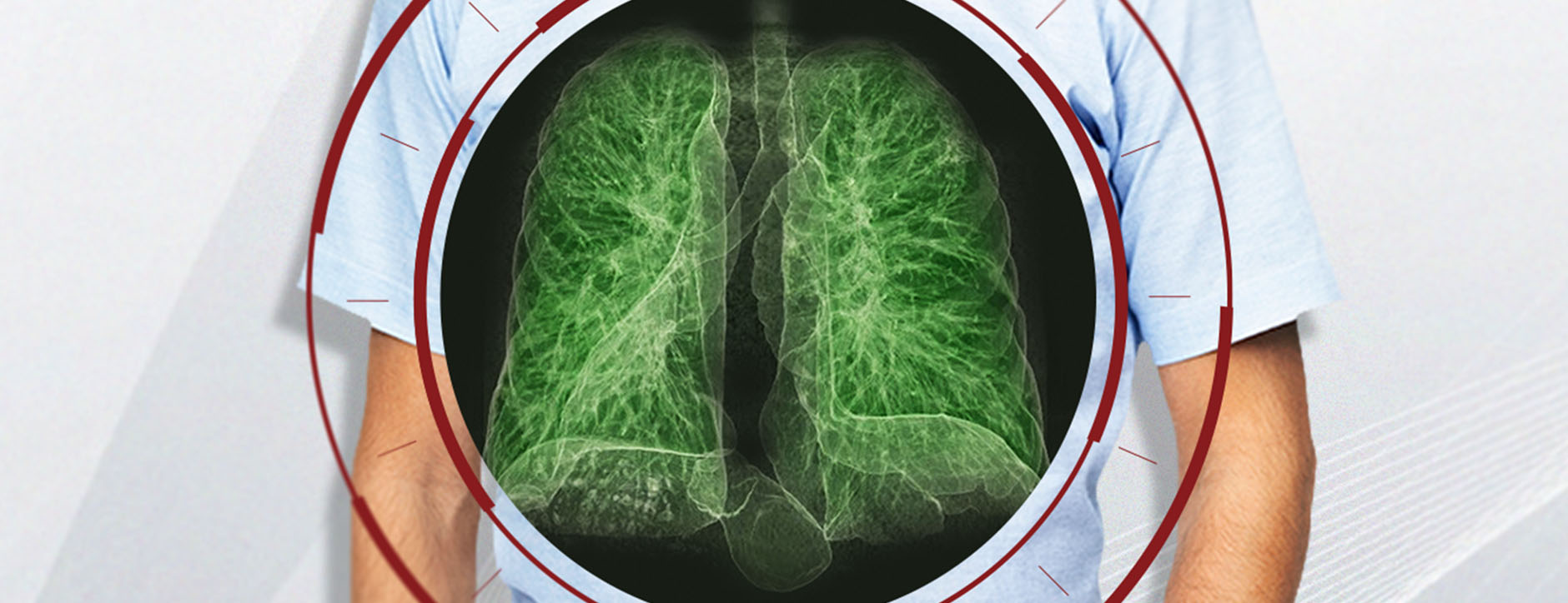 Low-Dose CT Lung Cancer Screening